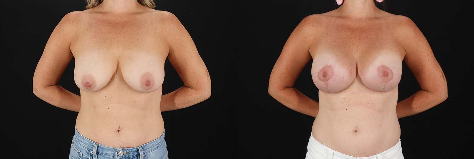 1-20139-49508-Breast-Lift-with-Implants-before-and-after-photo-by-Dr.-Erika-A.-Sato-in-Houston-TX-1