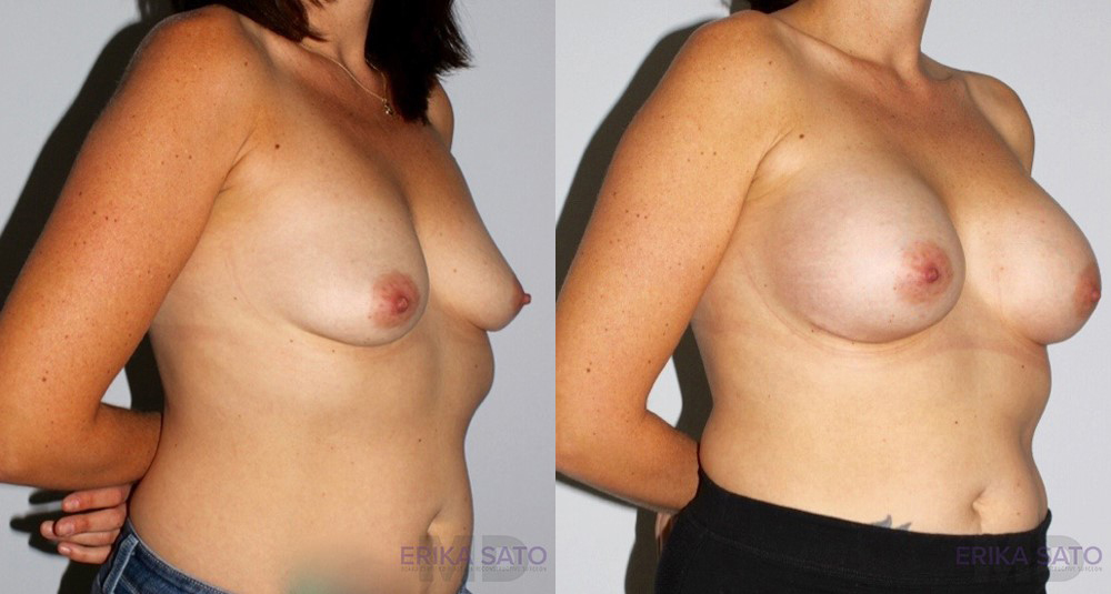 Breast Augmentation case #5622