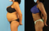 Liposuction case #6014 slider thumbnail