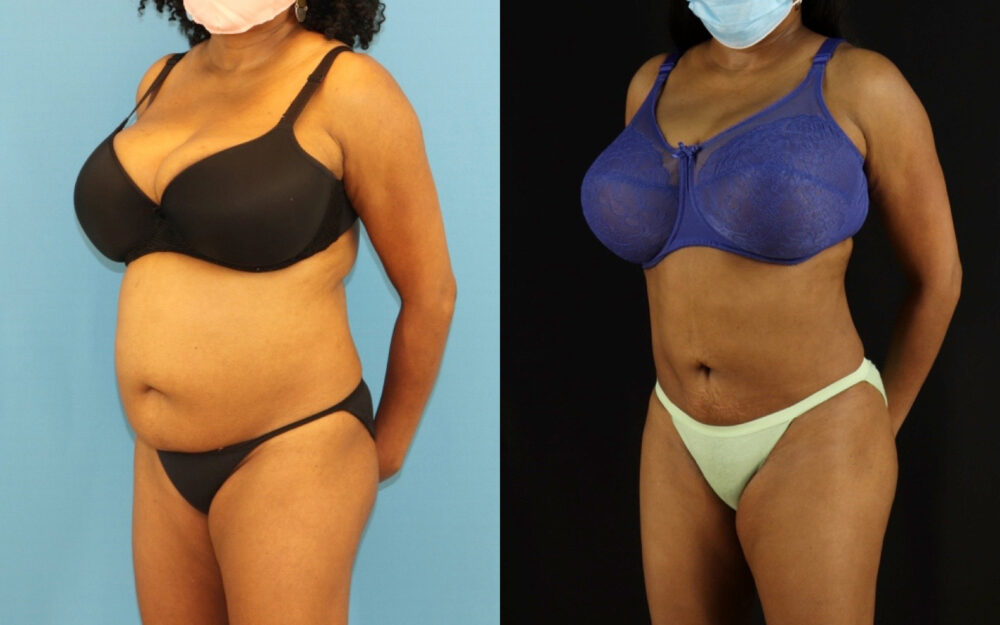 Liposuction case #6014