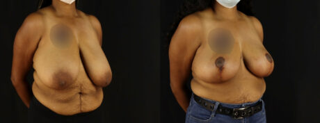 Breast Reduction case #7969