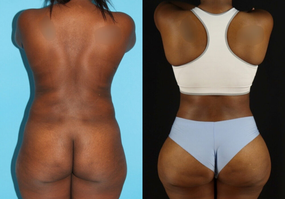 Brazilian Butt Lift case #4766