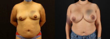 Breast Augmentation case #6384