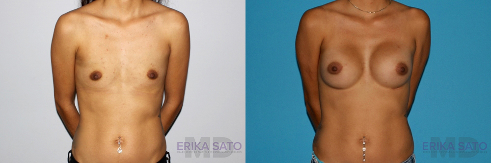 Breast Augmentation case #5618