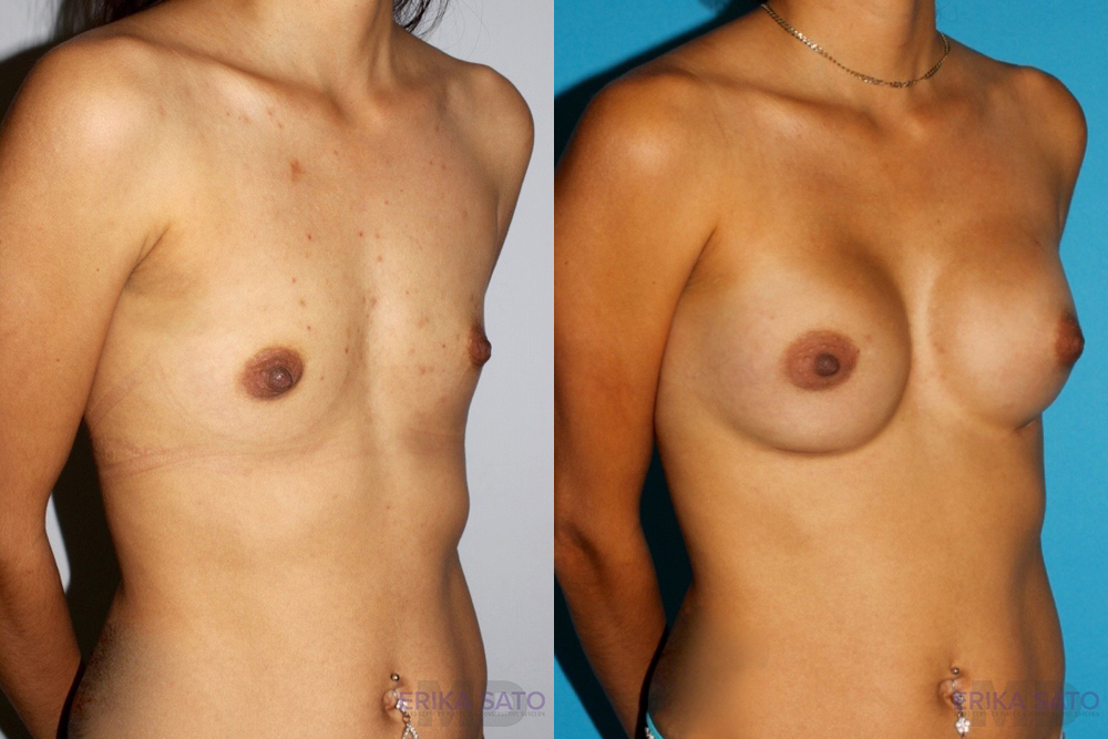 Breast Augmentation case #5618