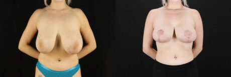 Breast Reduction case #7982