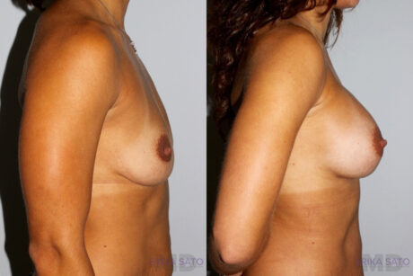 Breast Augmentation case #5614