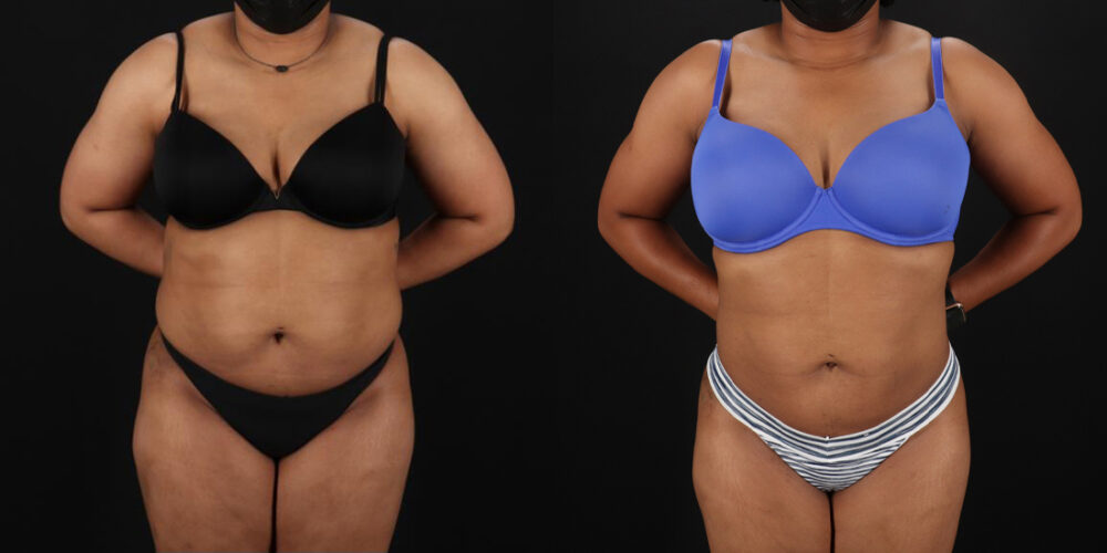 Liposuction case #6015