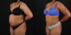 Liposuction case #6015 slider thumbnail