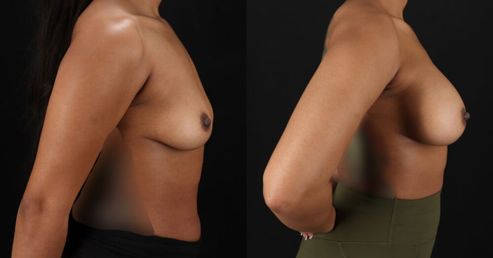 Breast Reduction case #8031