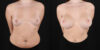 Breast Augmentation case #6396 slider thumbnail