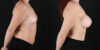 Breast Augmentation case #6396 slider thumbnail