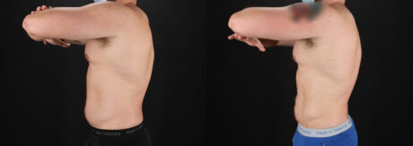 Liposuction case #6113