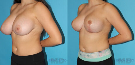 Breast Reduction case #7936