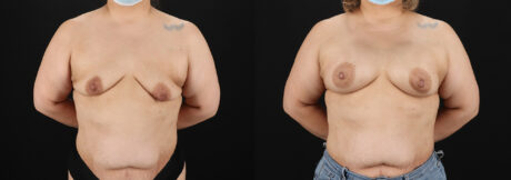 Breast Augmentation case #6420