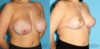 Breast Reduction case #7928 slider thumbnail