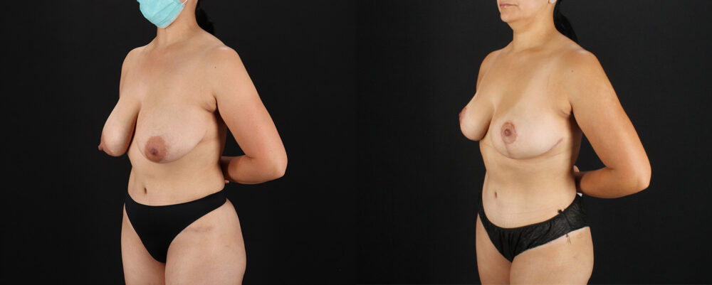 Breast Lift case #7792