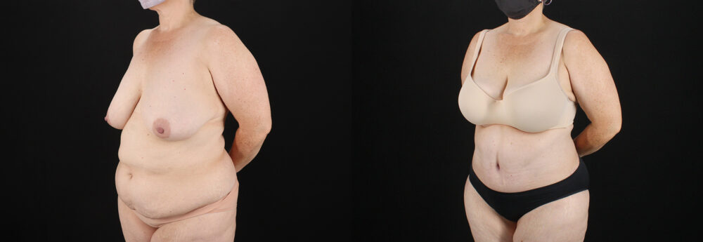 Tummy Tuck case #7615