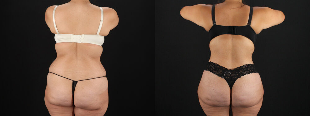 Tummy Tuck case #7613