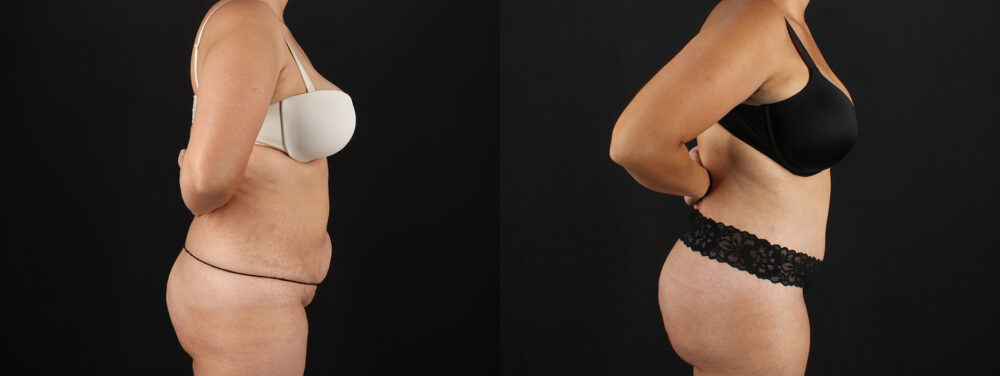 Tummy Tuck case #7613