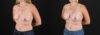 Breast Augmentation case #6438 slider thumbnail