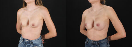 Revision Breast Surgery case #256261