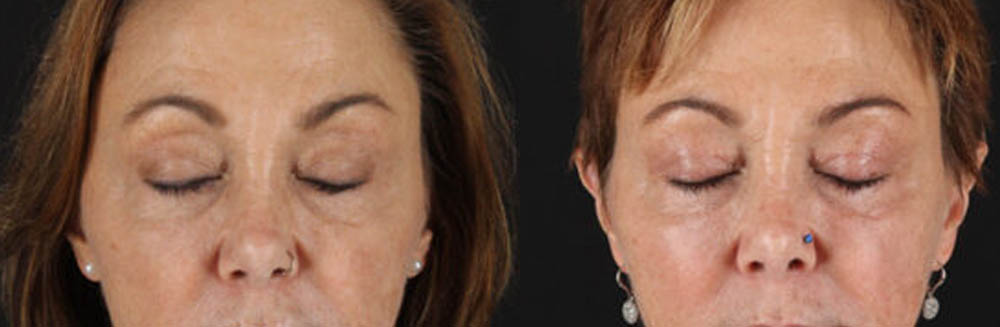 Blepharoplasty case #6889