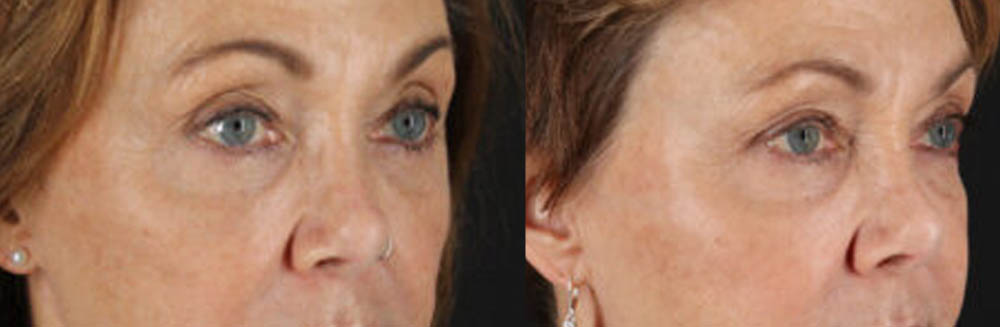 Blepharoplasty case #6889