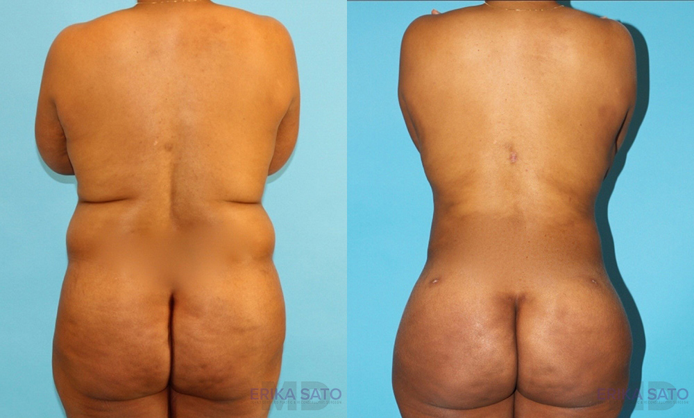 Brazilian Butt Lift case #4452