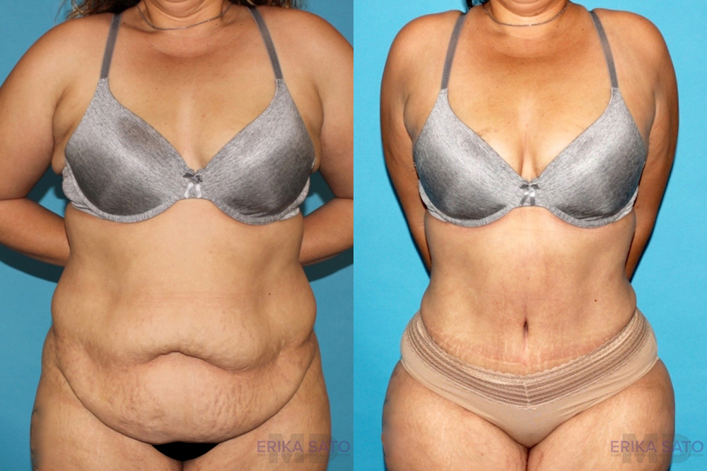 Tummy Tuck case #7226