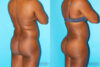 Brazilian Butt Lift case #4634 slider thumbnail