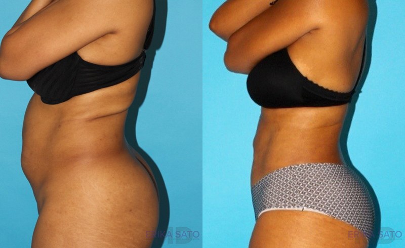 Liposuction case #5884