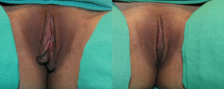 Labiaplasty case #5799