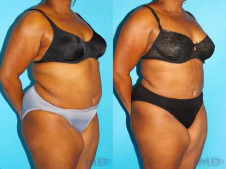 Liposuction case #5885