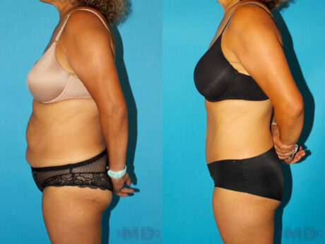 Tummy Tuck case #7233