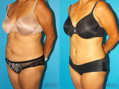 Tummy Tuck case #7233