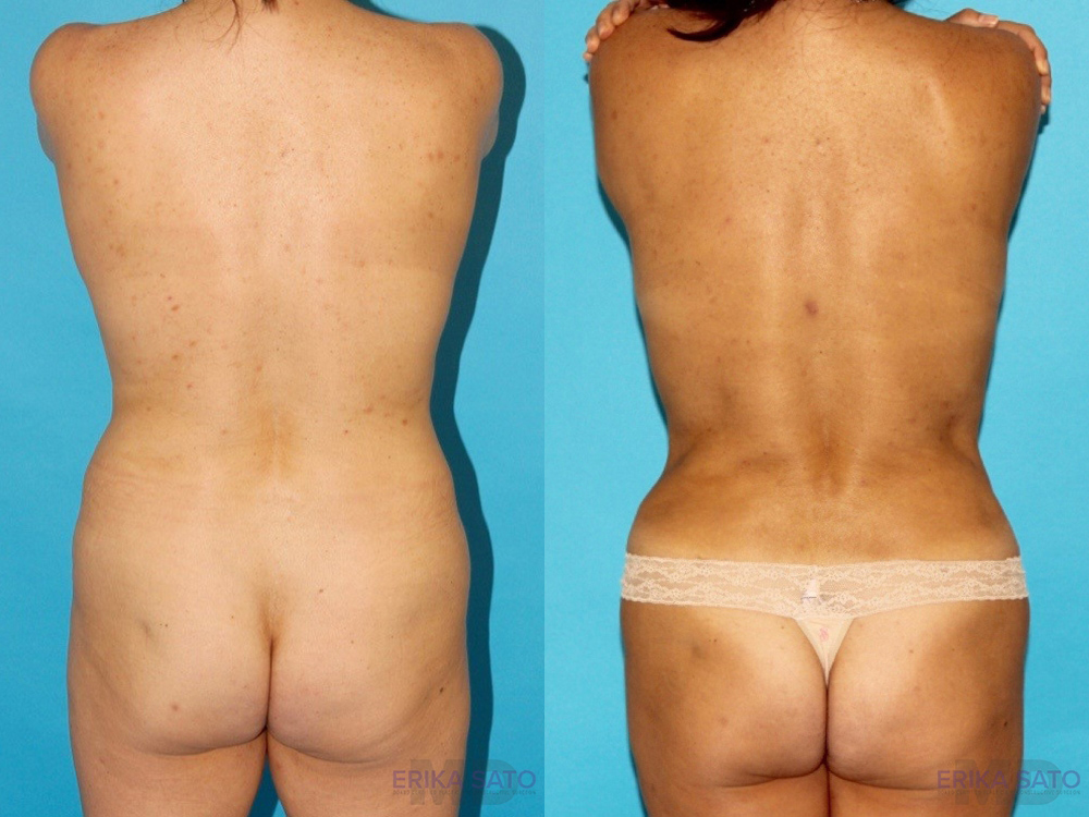 Liposuction case #5886