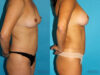 Liposuction case #5886 slider thumbnail