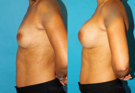 Breast Augmentation case #5653