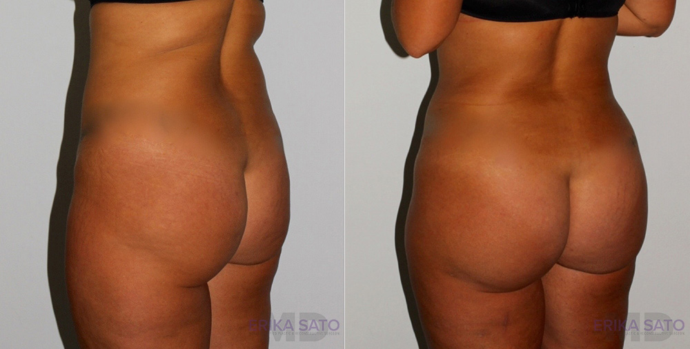 Brazilian Butt Lift case #4435