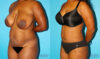 Liposuction case #5888 slider thumbnail