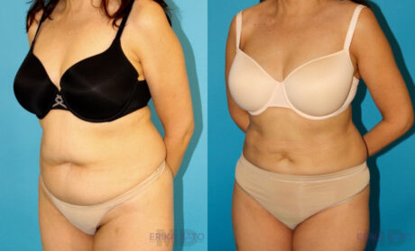 Liposuction case #5887