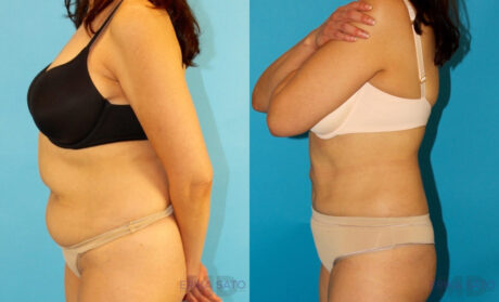 Liposuction case #5887