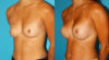 Breast Augmentation case #5997 slider thumbnail