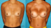 Breast Augmentation case #5997 slider thumbnail