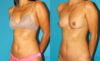 Liposuction case #5889 slider thumbnail