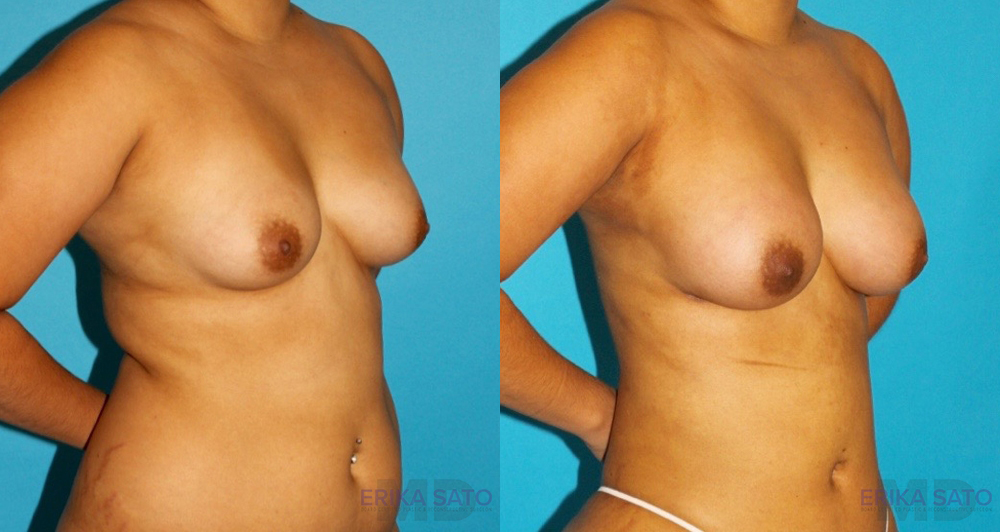 Fat Grafting to the Breast case #256162