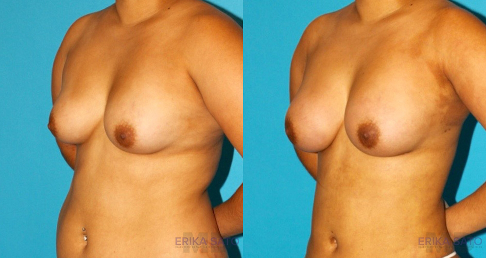 Fat Grafting to the Breast case #256162