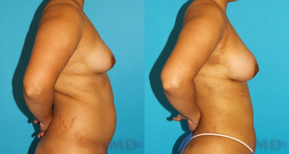 Fat Grafting to the Breast case #256162