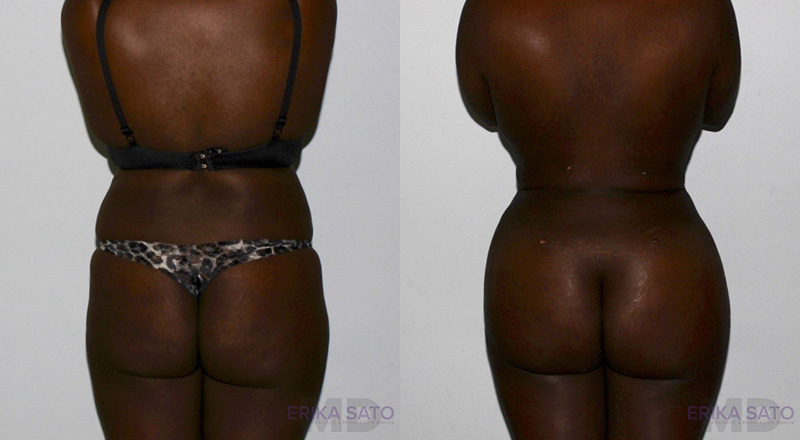 Brazilian Butt Lift case #4625